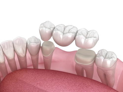 Dental Bridge in Huntsville, AL | Book a Free Implant Consultation2