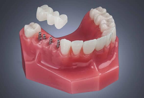 Dental Bridge in Huntsville, AL | Book a Free Implant Consultation