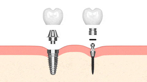 Dental Implants in Huntsville, AL | Book a Free Implant Consultation