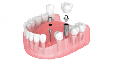 Mini Dental Implants in Huntsville, AL | Book a Free Consultation