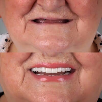 Dentures in Huntsville, AL | Affordable Dentures & Implants