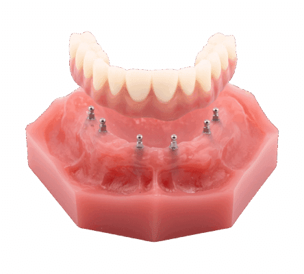 Full Arch Dental Implants in Huntsville, AL | Free Consultations