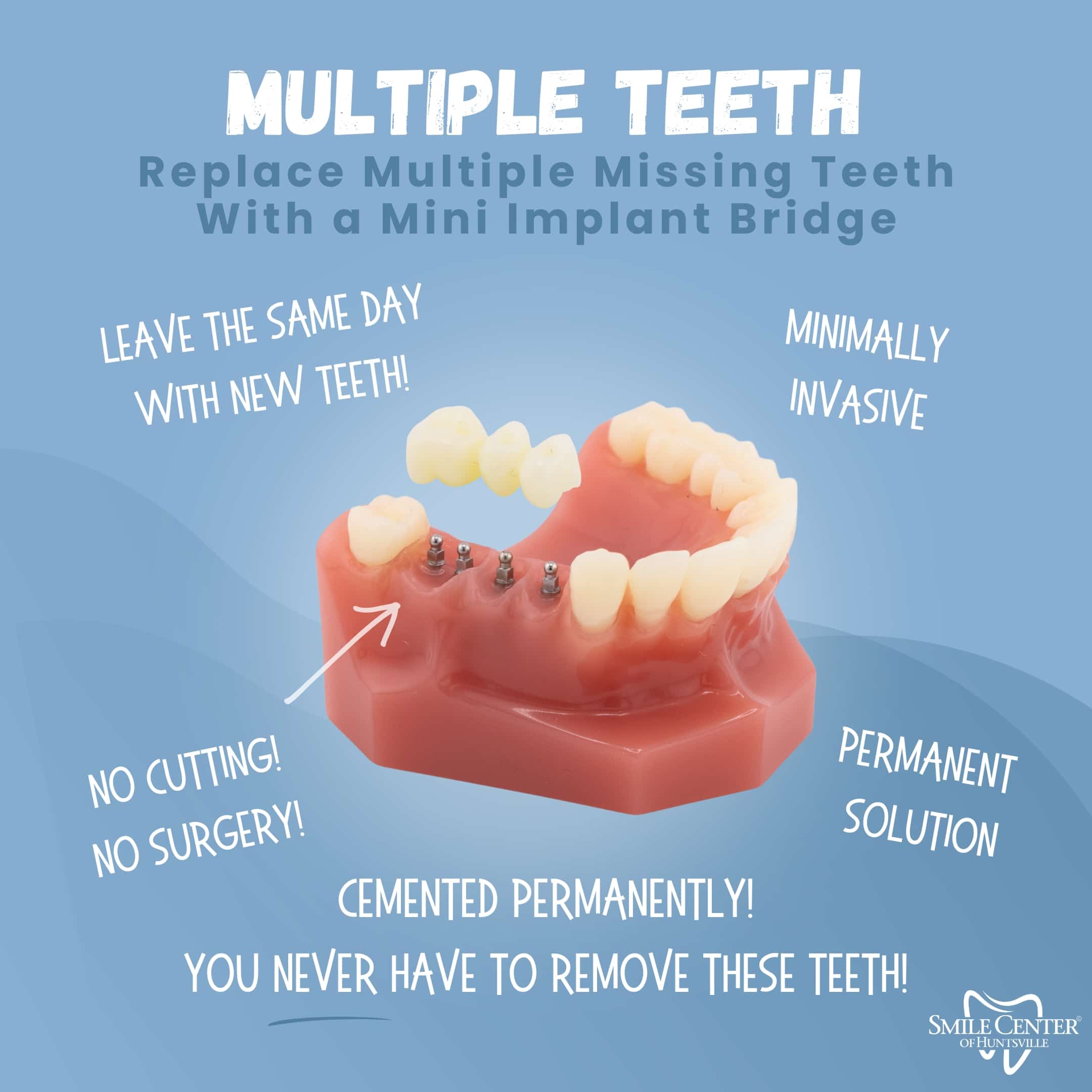 Multiple Tooth Replacement in Huntsville, AL