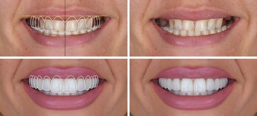 Porcelain Veneers Process | Affordable Veneers in Huntsville, AL