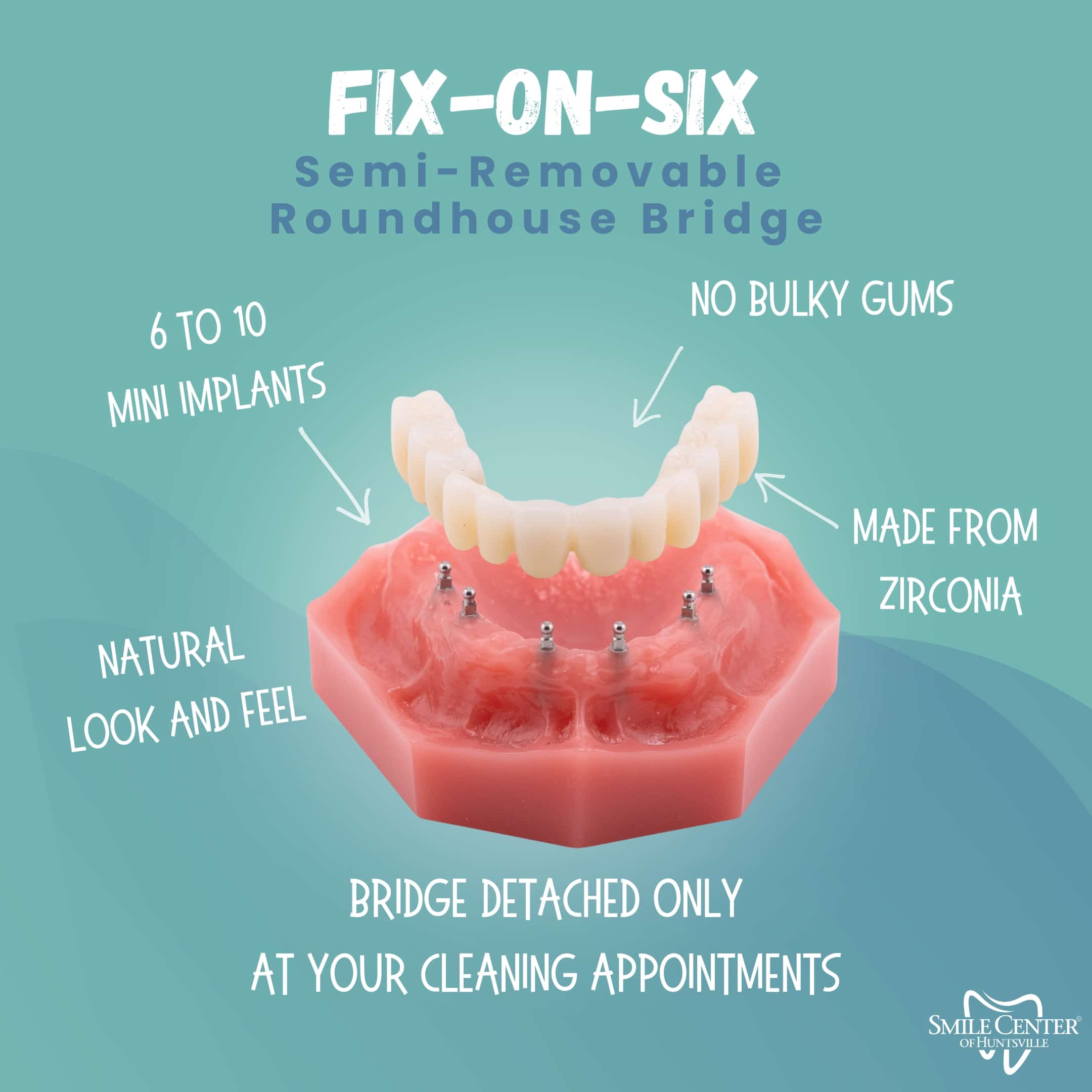 Removable Implant Bridge in Huntsville, AL