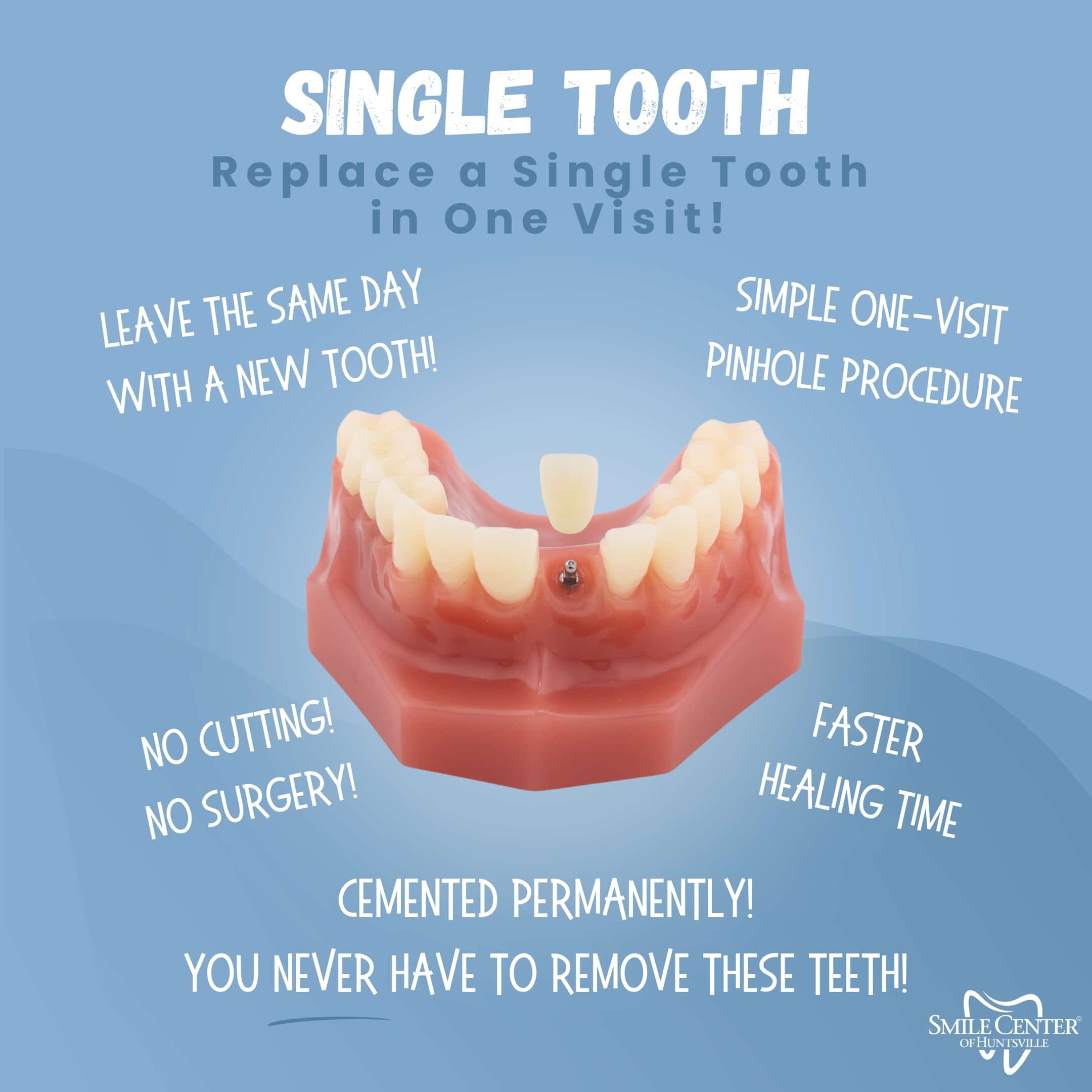 Single Tooth Replacement in Huntsville, AL