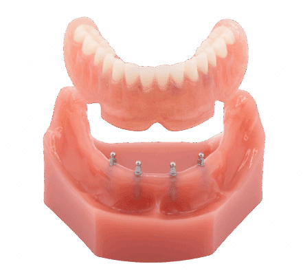 Snap-In Dentures in Huntsville, AL | Implant Dentures Near Me