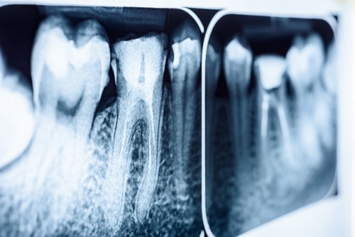 Root Canal Treatment in Huntsville, AL | Signs You May Need Care