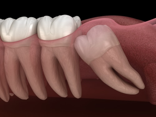 Do You Remove Wisdom Teeth Oral Surgery in Huntsville, AL