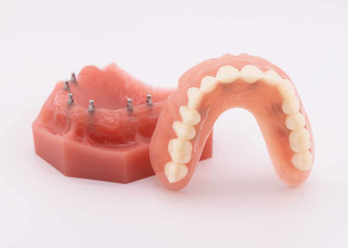 Floating Dentures | Affordable Implant Options in Huntsville, AL