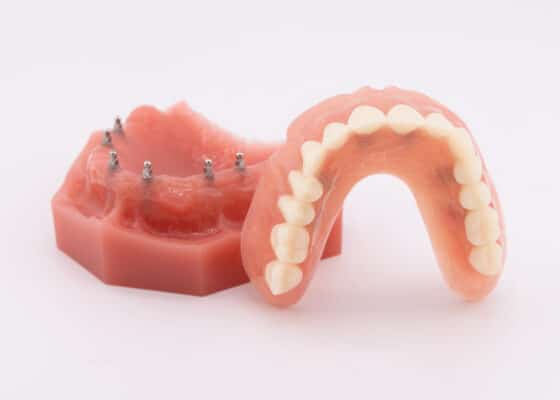 Floating Dentures | Affordable Implant Options in Huntsville, AL
